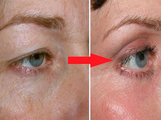 Trápi vás problém s povislými očnými viečkami? Návod ako sa zbaviť povislých viečok