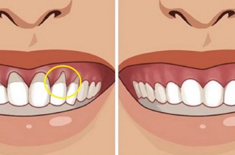 Prírodná lekáreň na odhalené zubné krčky a bolesti ďasien, ktorú odporúča zubár. Ďasná budú zdravé a bez bolesti.