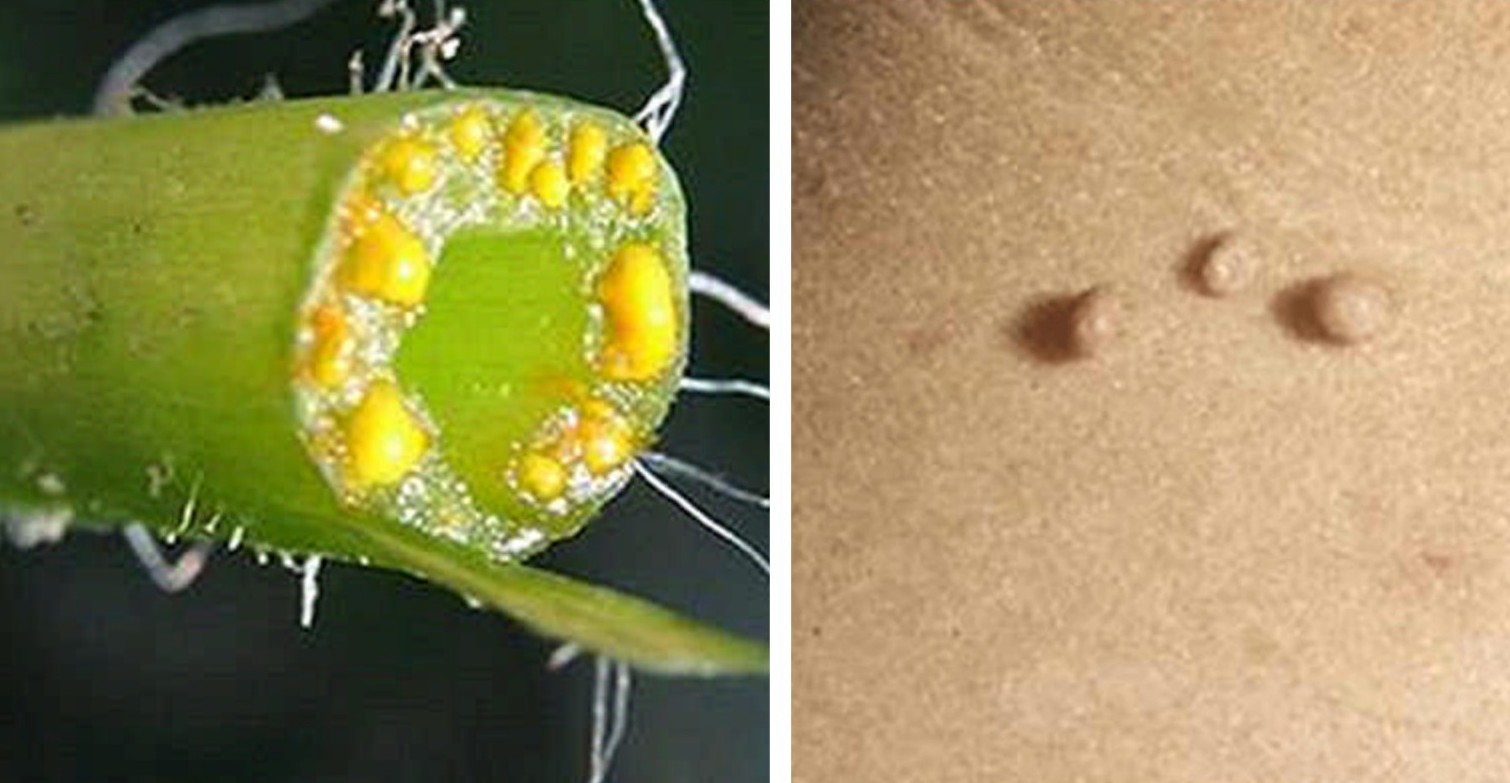 Trápia vás bradavice na vašom tele? Poznáme návod, ako ich bezpečne odstrániť!