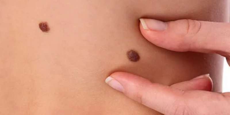 Známky toho, že máte rakovinu, ale nikdy ste tomu nevenovali pozornosť!