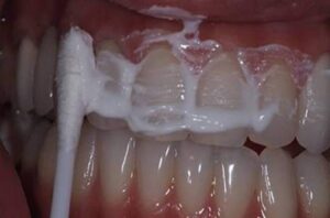 Rady od ženy zubára: Ako si vybieliť zuby a zbaviť sa zubného kameňa za 4 minúty