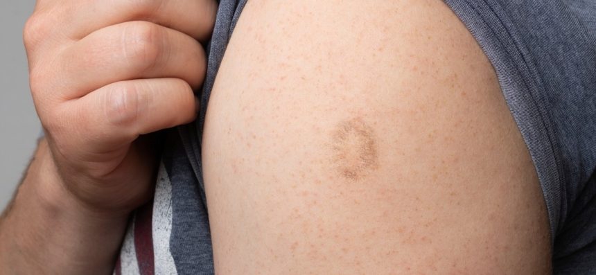 Pozrite sa na svoju ľavú pažu. Je tam malá jazvička? Prezradíme, čo to znamená