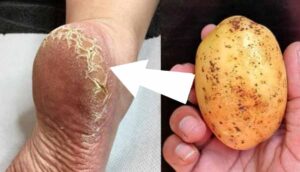 Paty ako bábätko vďaka jednoduchej domácej kôre: Účinný recept na popraskanú kožu